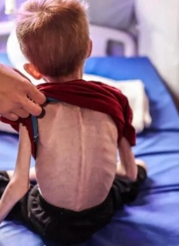 WHO: 112 Children Admitted to Gaza Hospitals Daily Due to Malnutrition